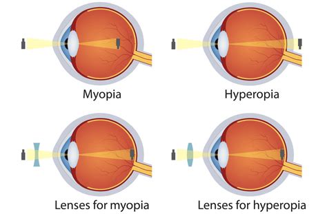 myopia vs hyperopia.